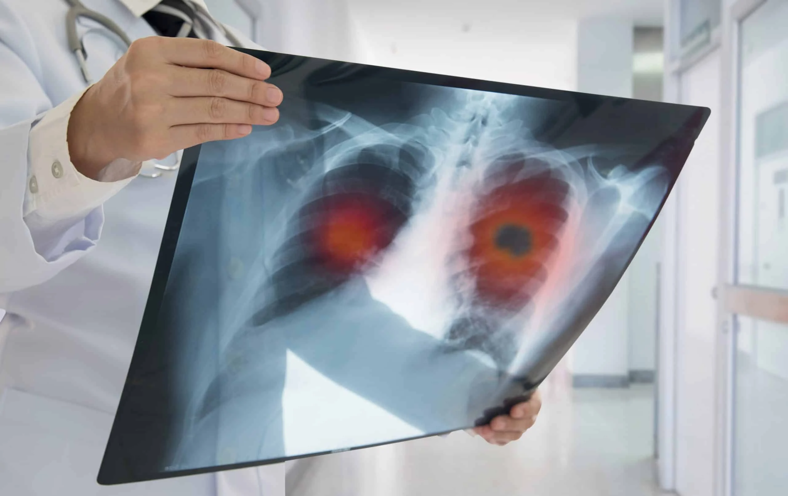 Vacina que previne câncer de pulmão: LungVax inicia testes em humanos, com tecnologia de Oxford e AstraZeneca e foco em alto risco Vacina que previne câncer de pulmão será testada em humanos
