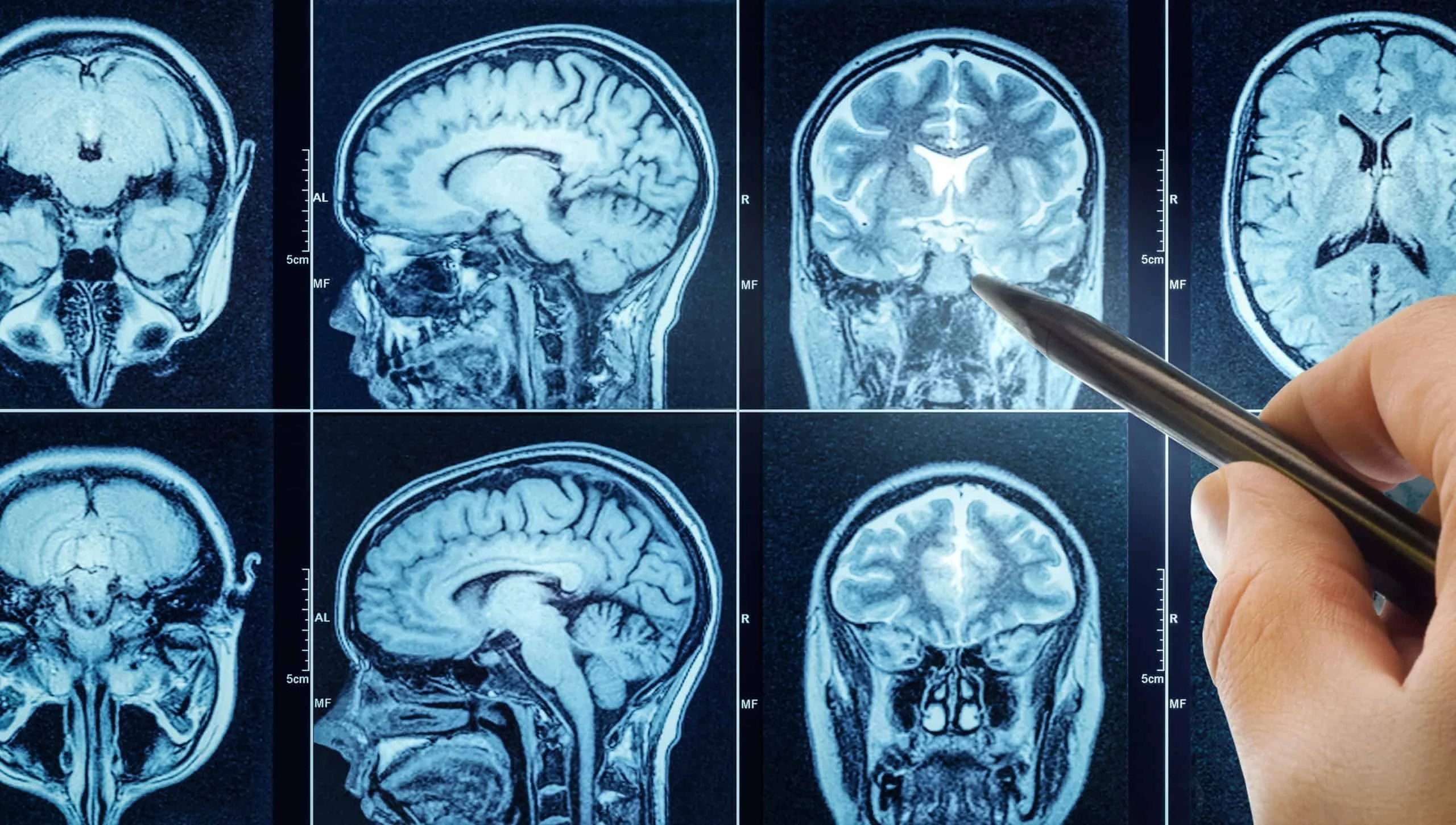 Remédio para pressão alta hidralazina bloqueia ADO e freia glioblastoma, aponta estudo da Universidade da Pensilvânia Famoso remédio para pressão alta surpreende ao impedir avanço de tumor cerebral